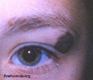pigmented nevus - left upper lid near outer canthus