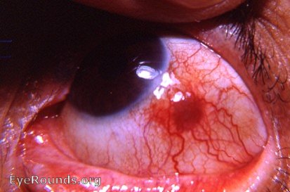 sclera: residual plaque of thinned sclera following nodular scleritis.