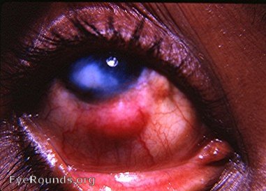 nodular scleritis with keratitis