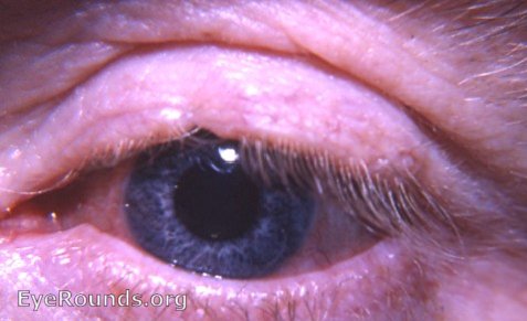 notching of upper lid margin with trichiasis - result of trauma 
