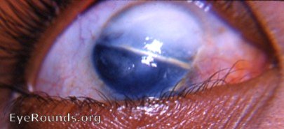 opaque cornea as a result of a perforating, linear laceration due to broken glass