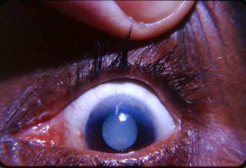 Pannus -superior limbus with Morgagnian cataract