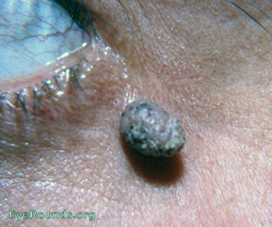 papilloma of lid