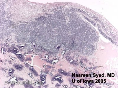 retinoblastoma