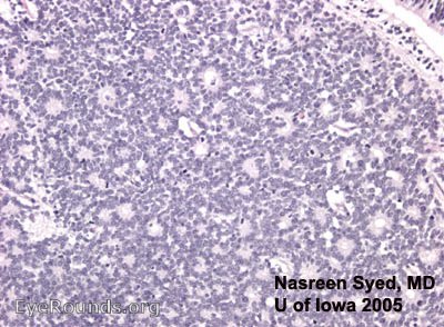 retinoblastoma