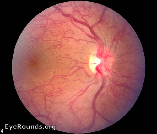 Proliferative diabetic retinopathy - advanced, uncontrolled