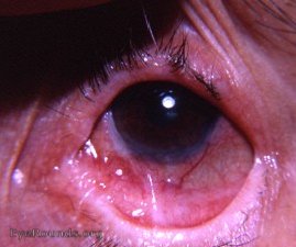 meibomian gland cyst