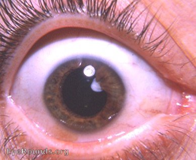 persistent pupillary membrane with anterior polar-like cataract. Very similar to the second photo in another patient.