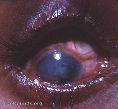 phthisis bulbi: unique cuff link deformation of cornea caused by smallpox  - photo 1966