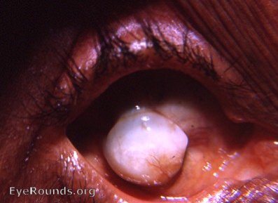 phthisis bulbi: unique cuff link deformation of cornea caused by smallpox  - photo 1966
