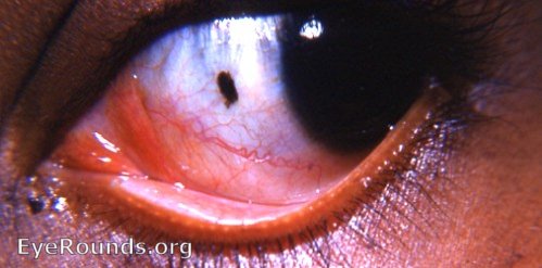 pigmented nevus of conjunctiva OS