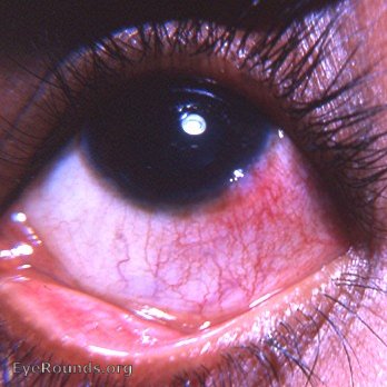 phylectenular keratoconjunctivitis - PKC