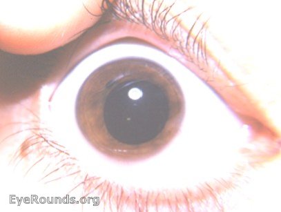 polycoria double pupil eye