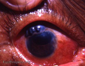 prolapse of the iris following cataract surgery