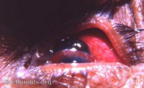 postop cataract complication: massive prolapse of the iris