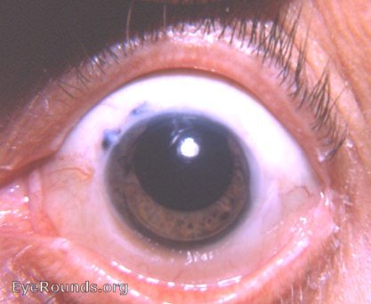 Intracapsular cataract extraction with complete iridectomy and iris prolapse