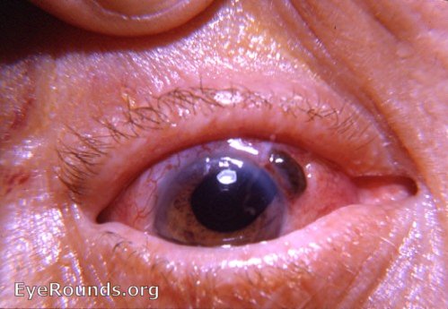 iris: prolapsed iris following intracapsular cataract surgery with 180 degree incision