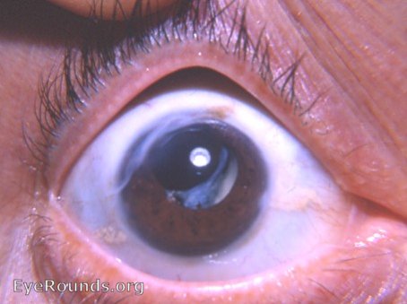 ragged von Graefe incision, secondary cataract ( aftercataract ), and pingueculae