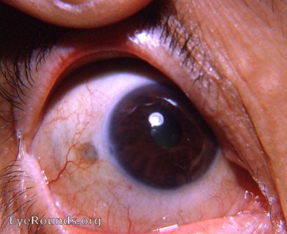 nodular scleritis: residual scleral thinning