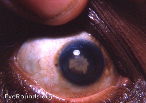 traumatic rosette cataract - a perfect example