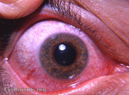 rust foreign body in cornea