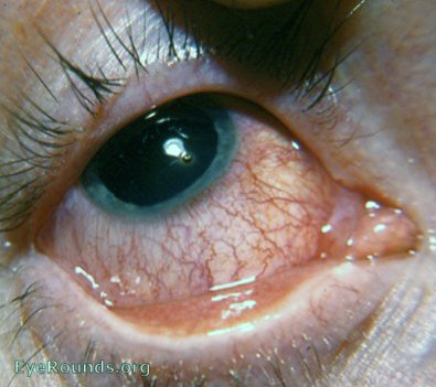 rust foreign body in cornea
