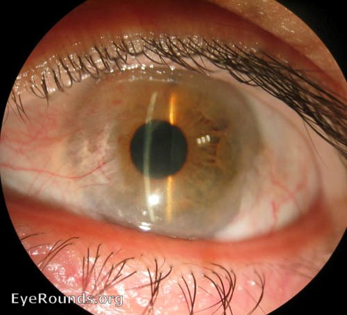 Salzman's nodular degeneration