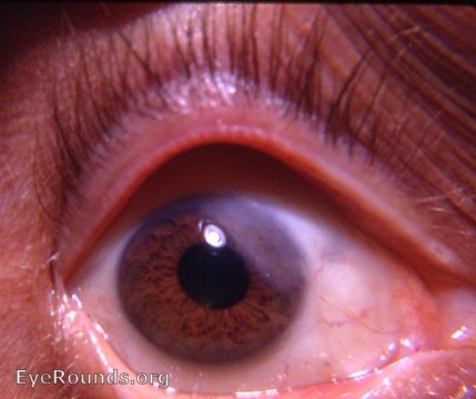 keratitis: sclerosing keratis - a further discussion