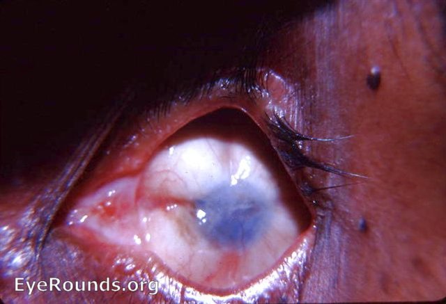 Phthisis bulbi following perforating smallpox ulcus serpens