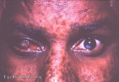 smallpox: heavily vascularized, large adherent leukoma OD and smaller off-center adherent leukoma OS