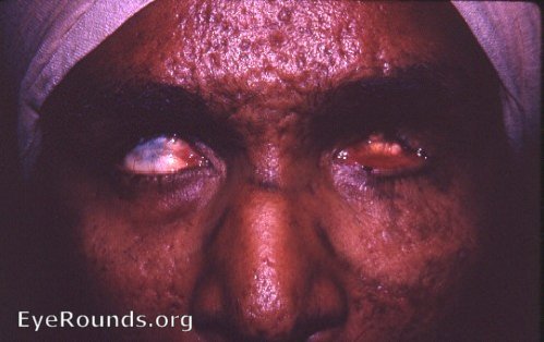 smallpox:  total blindness resulting from phthisis bulbi OU due to perforating hypopyon ulcers during smallpox attack.