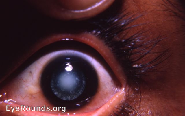Congenital cataract, left eye
