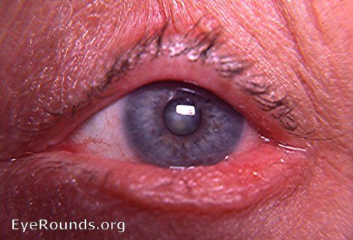 ectropion of lower lid due to squamous cell carcinoma of tarsal conjunctiva