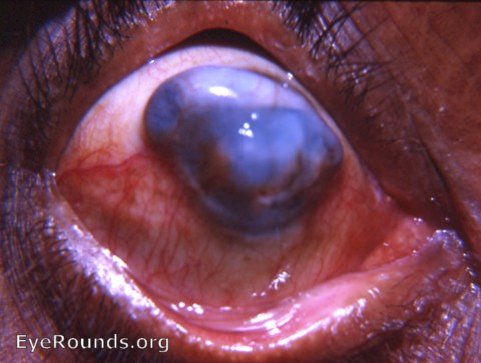 corneal staphyloma following sutureless cataract surgery complicated by huge iris prolapse