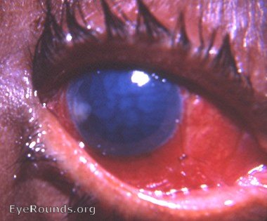 pronounced striate keratitis following intracapsular cataract surgery