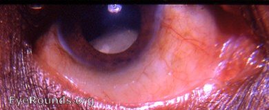 subluxated cataractous lens - spontaneous