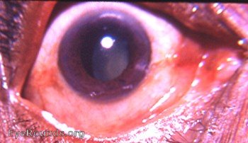 subluxated cataract
