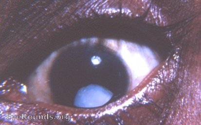 subluxated cataract