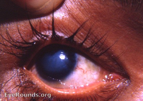 interstitial keratitis with congenital syphilis