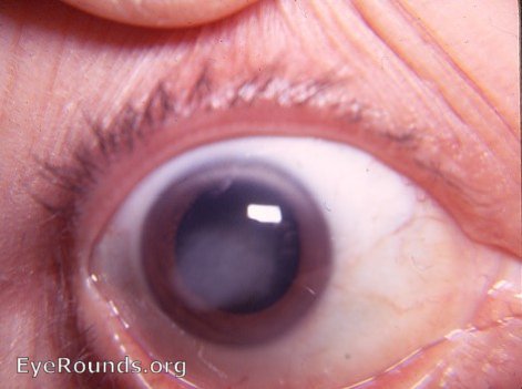 interstitial keratitis syphilis