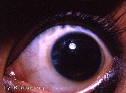 tattooed cornea