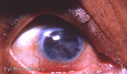 tattooed leukomatous cornea in an eye that is going into phthisis bulbi following unsuccessful cataract surgery