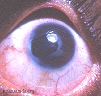 tattooing of cornea : same two photographs under different lighting and contrast to make tattooed areas mor conspicuous -2