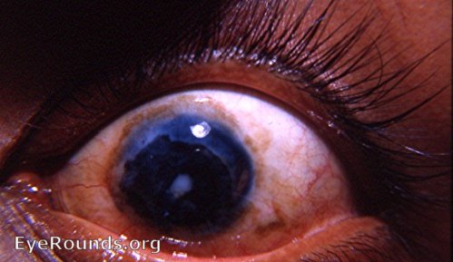 black corneal tattooing