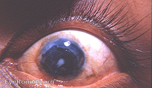 tattooing of cornea : same two photographs under different lighting and contrast to make tattooed areas mor conspicuous -2