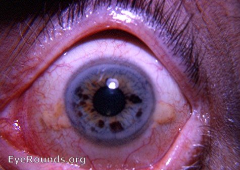tigroid iris: with a number of dark-brown nevi