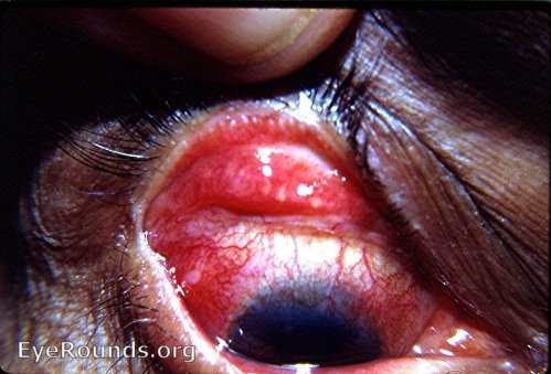 Trachoma - follicles of stage I of MacCallan's classification