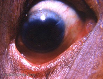 trachoma: limbal arcade vs pannus