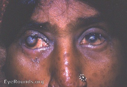 smallpox and trachoma: leukoma of each cornea; trichiasis, and facial pock marks.