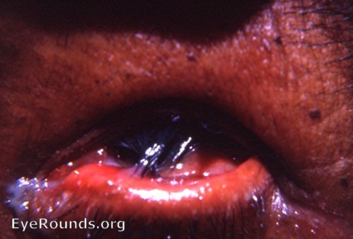 trachoma: extreme trichiasis